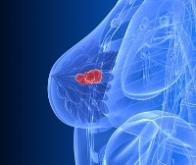 Une puce électronique pour détecter les cancers du sein