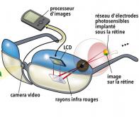 Une rétine artificielle sans fil