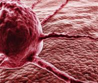 Une technologie innovante pour combattre le cancer