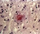 Maladie d'Alzheimer : la protéine bêta amyloïde révélée à l'échelle de l'atome