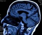 Maladie d’Alzheimer : un test sanguin analysé par l'IA prédit la neurodégénérescence