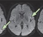 Maladie d'Alzheimer: une étude confirme la non-transmissibilité des protéines chez l'homme