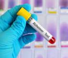 Maladie d’Alzheimer : vers un test sanguin fiable détectant des oligomères toxiques des années avant le diagnostic