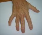 Arthrose : vers une thérapie cellulaire injectable