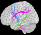 Autisme : découverte de nouvelles spécificités structurelles dans le cerveau