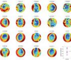 Autisme : des différences de structure découvertes dans le cerveau