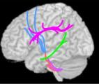 Autisme : la connectivité des aires cérébrales mise en cause ?