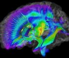 Autisme : l’imagerie cérébrale, une aide au diagnostic précoce?