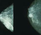 Bloquer les gènes responsables du cancer du sein avec des nanoparticules...