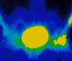 Cancer de la prostate : identification d’une nouvelle cible thérapeutique et d’un marqueur pronostique