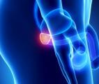 Cancer de la prostate : un complément à base de brocoli pour retarder l’hormonothérapie ?