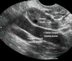 Cancer de l'ovaire : une biopsie liquide pour détecter la récidive