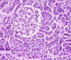 Cancer du pancréas : découverte d'une nouvelle voie d'activation génétique