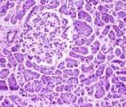 Cancer du pancréas : une nouvelle combinaison de molécules à l'essai