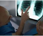 Cancer du poumon avancé : excellents résultats pour un nouvel anticorps