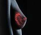Cancer du sein : le cholestérol impliqué dans les récidives