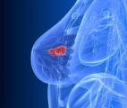 Cancer du sein : pourquoi les métastases gagnent les os