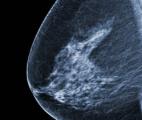 Cancer du sein : un vaccin thérapeutique donne de bons résultats 