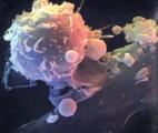 Cancer : une immunothérapie progressive, sous forme de gel