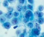 Cancers de l’ovaire : Découverte d’une double signature prédictive de l’agressivité tumorale et de la réponse au traitement