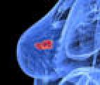 Cancers du sein : découverte d’un marqueur du risque de métastases pulmonaires