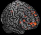 Certaines modifications de l'activité cérébrale pourraient annoncer la schizophrénie