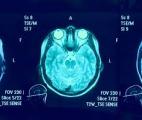 Commotion cérébrale : un refroidissement contrôlé des cellules du cerveau pour limiter les dégâts