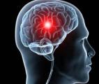 De légères différences dans le cerveau des personnes souffrant de trouble du déficit de l’attention