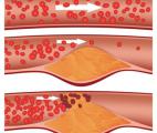 Découverte de l’ultra-mauvais cholestérol