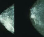 Découverte des cellules à l'origine du cancer du sein