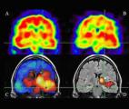 Découverte d’un nouveau mode de propagation des crises d'épilepsie dans le cerveau