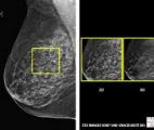 Dépistage du cancer du sein : la tomosynthèse fait mieux que la mammographie classique