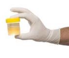 Dépister le cancer de l'utérus grâce à un simple test urinaire