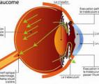 Des lentilles pour traiter le glaucome