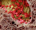 Des nanoparticules capables de cibler et tuer des cellules cancéreuses