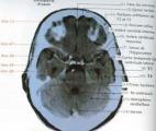 Des scanners cérébraux pour anticiper l'Alzheimer