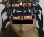Des stimulations électriques pour redonner la vue aux aveugles