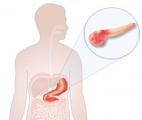 Deux médicaments améliorent le pronostic du cancer du pancréas