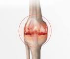 L’arthrose : un fléau mondial encore trop méconnu