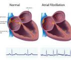Fibrillation atriale : un anticoagulant pourrait prévenir les AVC