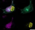 La ferroptose pour vaincre le cancer de la prostate résistant