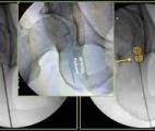 L’ablation par radiofréquence pour lutter contre l'arthrose du genou