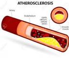 L'athérectomie orbitale pulvérise le calcium dans vos artères…