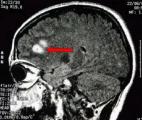 L'atrophie d'une région clé du cerveau associée à la sclérose en plaques
