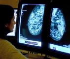 Le cancer du sein mieux pris en charge grâce à la médecine prédictive