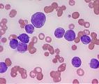 Le rituximab, nouveau traitement de référence contre les leucémies lymphoblastiques ?