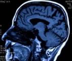 Le stress, facteur de risque dans la maladie d'Alzheimer ?
