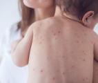Le vaccin contre la varicelle réduit l’incidence des infections invasives à streptocoque du groupe A