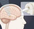 L’échographie focalisée permettrait de réguler de manière ciblée les activités cérébrales