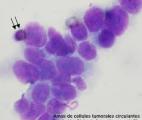 Les cellules tumorales circulantes, biomarqueur de pronostic dans le cancer de la vessie